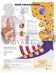 High Cholesterol Anatomical Chart